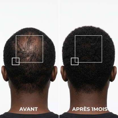Norgecare® - Sérum anti-chute cheveux