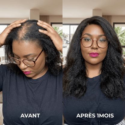 Norgecare® - Sérum anti-chute cheveux