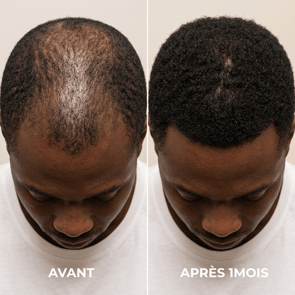 Norgecare® - Sérum anti-chute cheveux